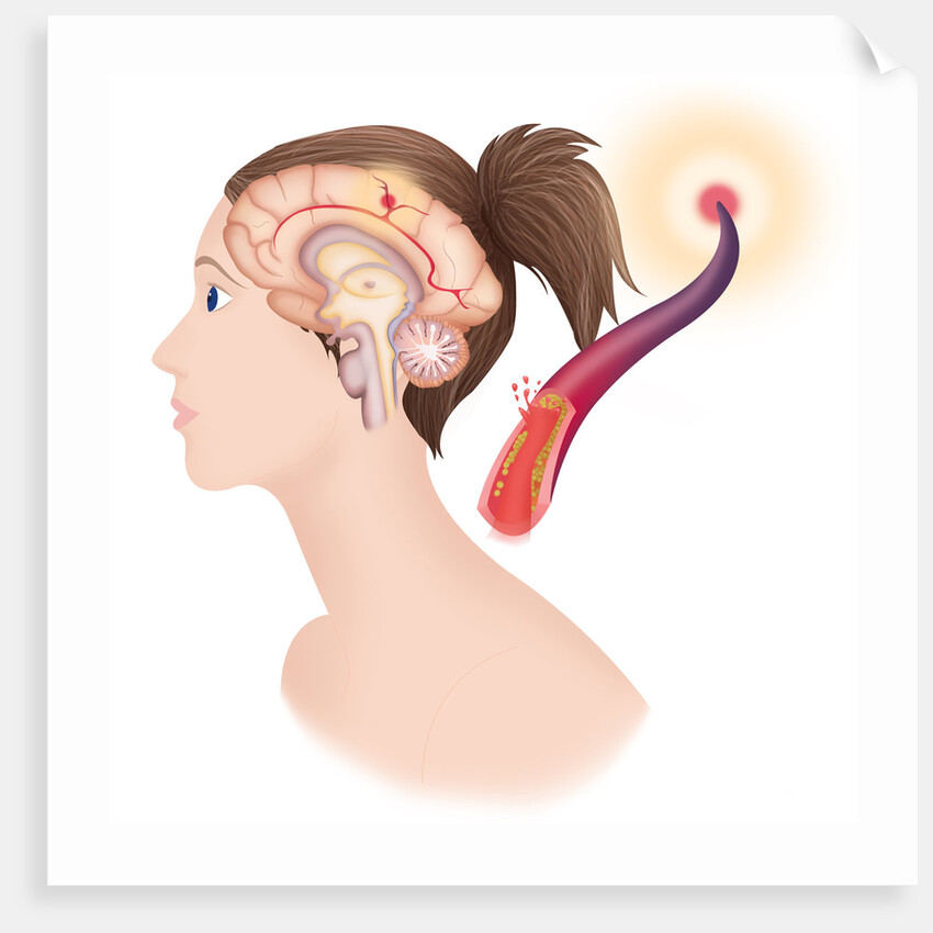 Cerebrovascular neurol. disease by Anonymous