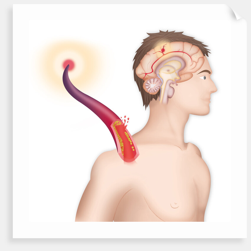 Cerebrovascular neurol. disease by Anonymous