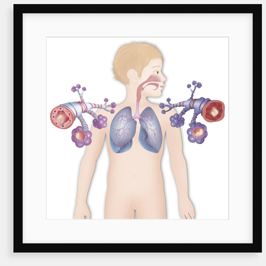 Asthma, drawing by Anonymous