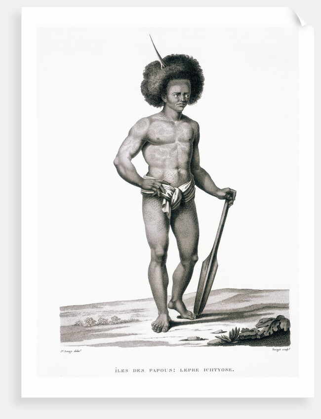 Papua Islands: Ichthyosis Leprosy Book Illustration by Anonymous