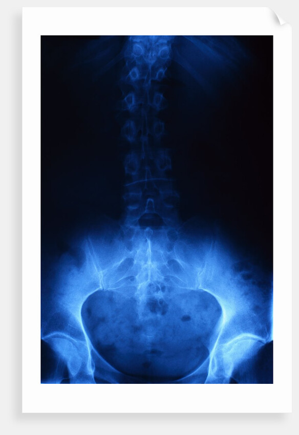 X-Ray of Human Lower Spine by Anonymous