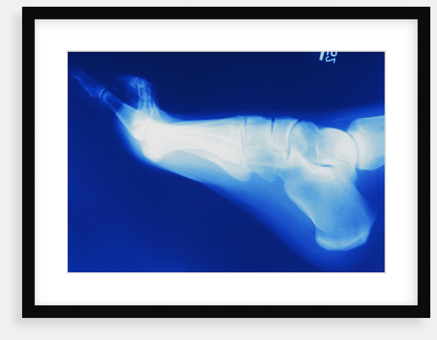 X-Ray of Person's Foot by Anonymous