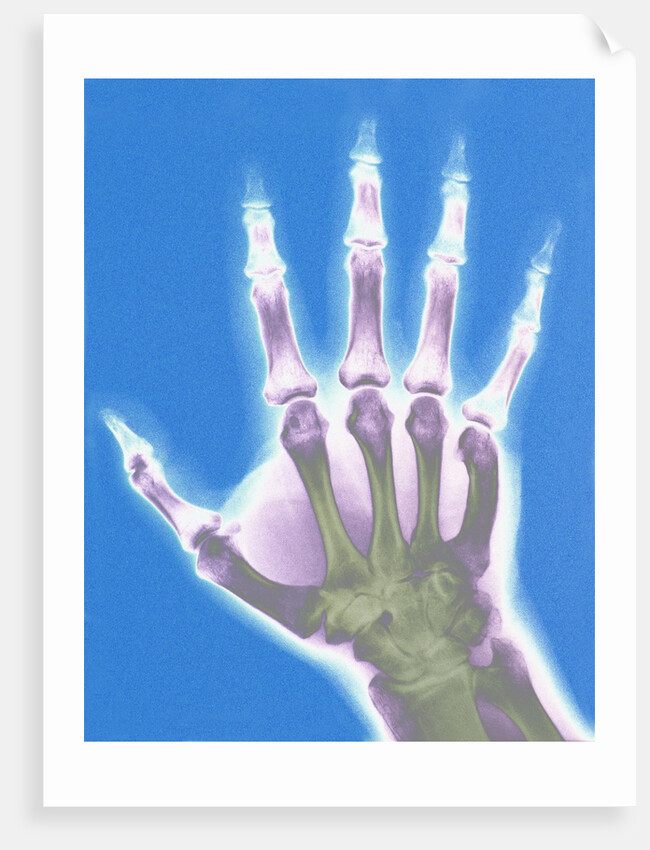 X-ray of a Hand by Anonymous