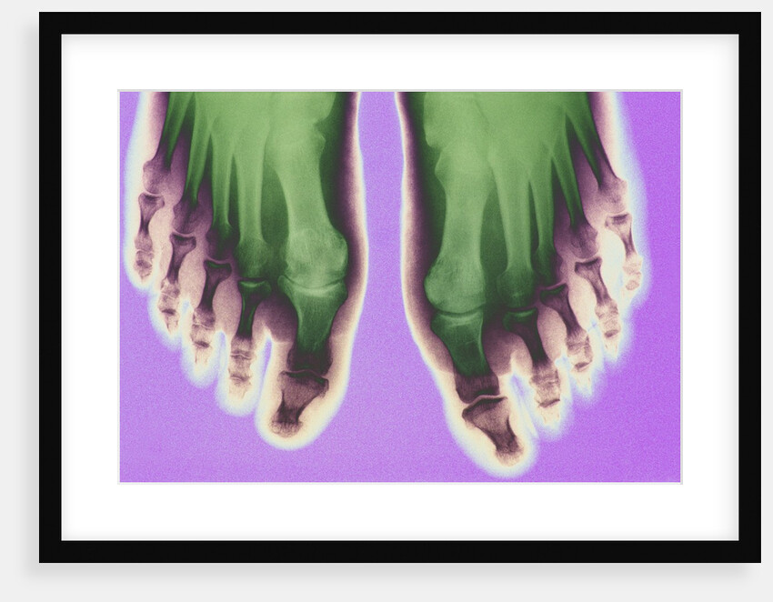 X-ray of Feet by Anonymous