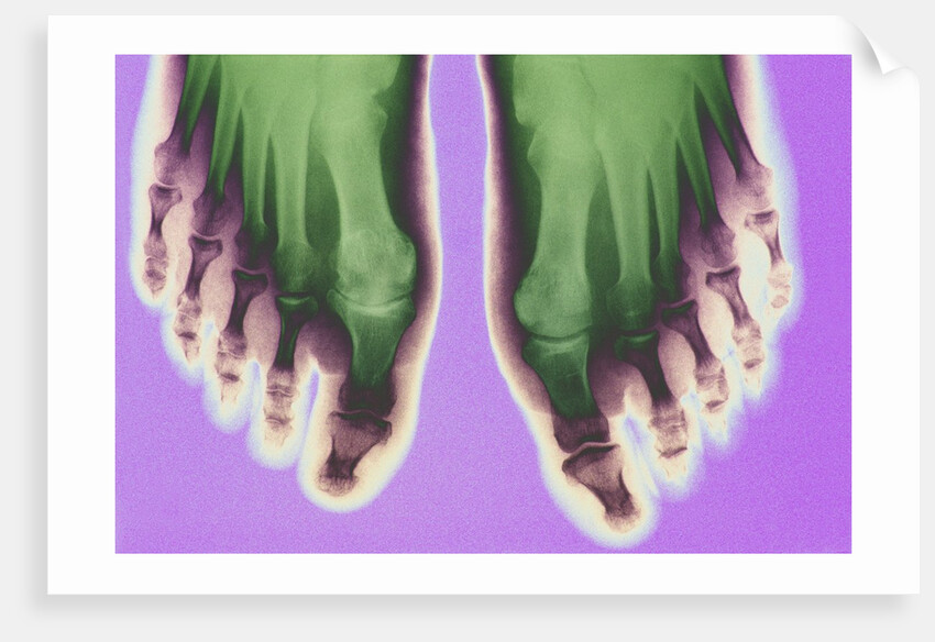 X-ray of Feet by Anonymous