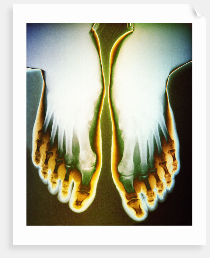 X-ray of Feet by Anonymous