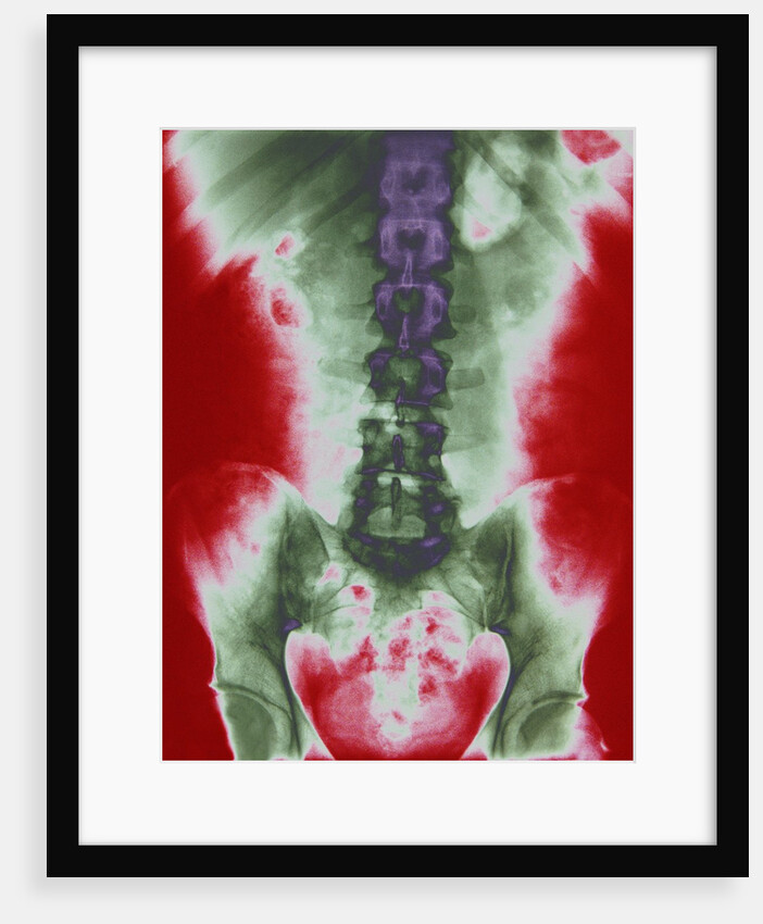 X-ray of a Torso by Anonymous