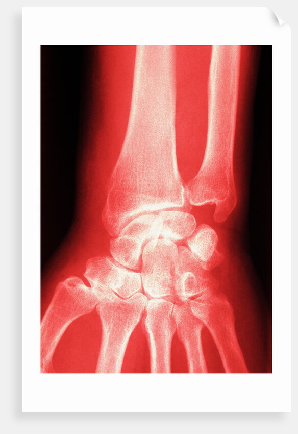 X-ray of a Wrist by Anonymous