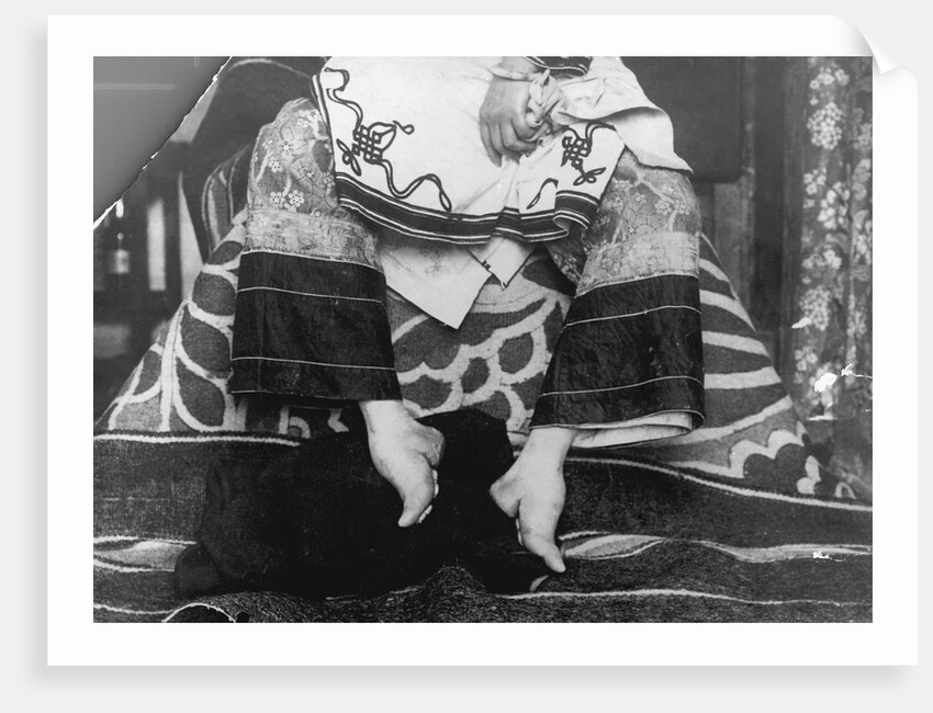 Chinese Woman Showing Emaciated Deformed Feet by Anonymous