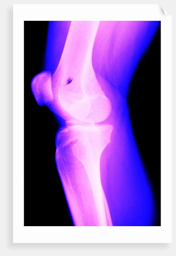 X-Ray of a Knee by Anonymous