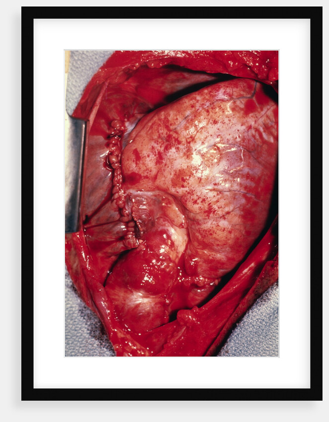 Donor's Heart in Thomas' Chest by Anonymous