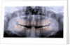 Panoramic X-Ray of Mouth by Anonymous
