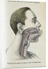 Polyp removal by Anonymous
