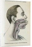 Polyp removal by Anonymous