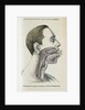 Polyp removal by Anonymous