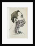 Polyp removal by Anonymous