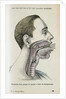 Polyp removal by Anonymous