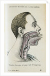 Polyp removal by Anonymous