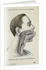 Polyp removal by Anonymous