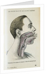 Polyp removal by Anonymous