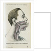 Polyp removal by Anonymous