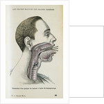 Polyp removal by Anonymous