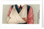 Arm in sling by Anonymous