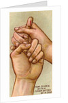 Bleeding finger by Anonymous