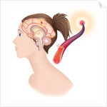 Cerebrovascular neurol. disease by Anonymous