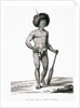 Papua Islands: Ichthyosis Leprosy Book Illustration by Anonymous
