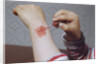 Placing Medicine on Infection by Anonymous