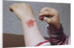 Placing Medicine on Infection by Anonymous