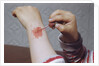 Placing Medicine on Infection by Anonymous