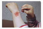 Placing Medicine on Infection by Anonymous