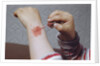 Placing Medicine on Infection by Anonymous