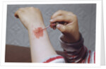 Placing Medicine on Infection by Anonymous