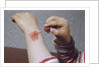 Placing Medicine on Infection by Anonymous