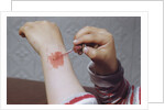Placing Medicine on Infection by Anonymous