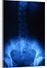 X-Ray of Human Lower Spine by Anonymous