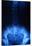 X-Ray of Human Lower Spine by Anonymous