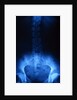 X-Ray of Human Lower Spine by Anonymous