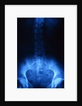 X-Ray of Human Lower Spine by Anonymous