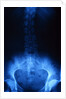 X-Ray of Human Lower Spine by Anonymous