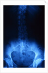 X-Ray of Human Lower Spine by Anonymous