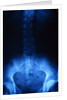 X-Ray of Human Lower Spine by Anonymous
