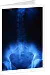 X-Ray of Human Lower Spine by Anonymous