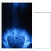 X-Ray of Human Lower Spine by Anonymous