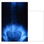 X-Ray of Human Lower Spine by Anonymous