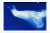 X-Ray of Person's Foot by Anonymous