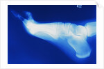 X-Ray of Person's Foot by Anonymous